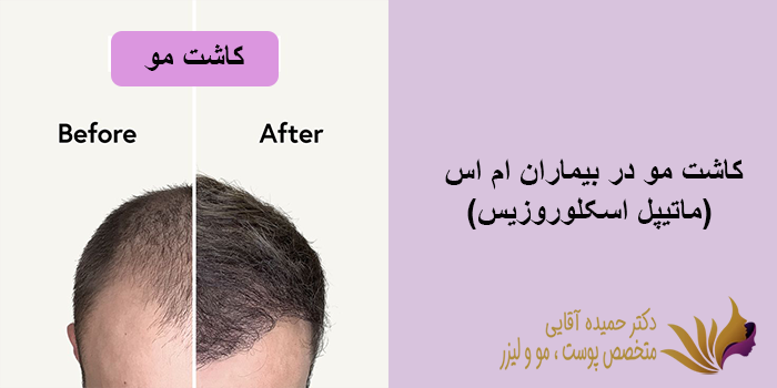 کاشت مو در بیماران ام اس