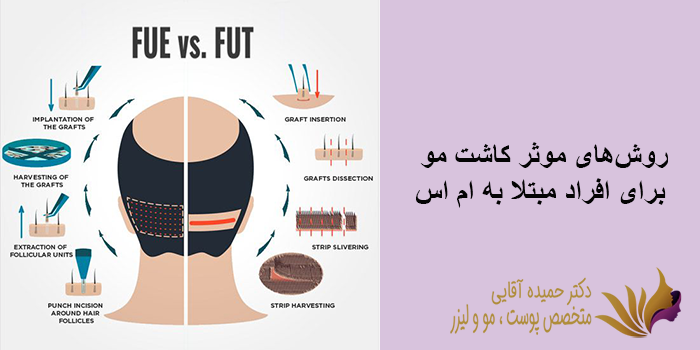 روشهای موثر کاشت مو برای افراد مبتلا به ام اس