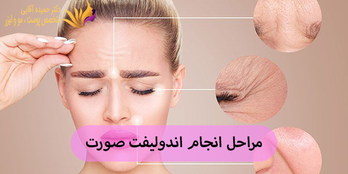 مراحل انجام اندولیفت صورت