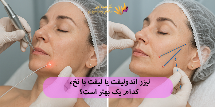 لیزر اندولیفت یا لیفت با نخ، کدام یک بهتر است؟