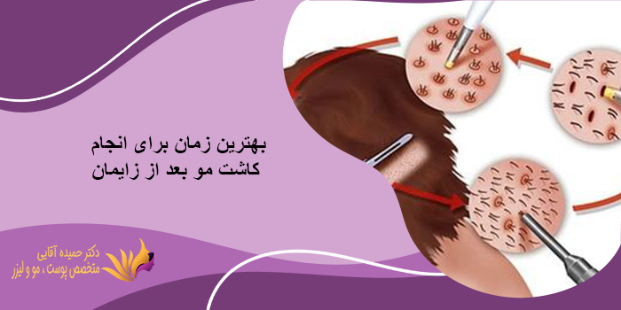 بهترین زمان برای انجام کاشت مو بعد از بارداری