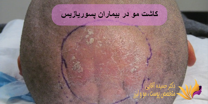 کاشت مو در بیماران پسوریازیس