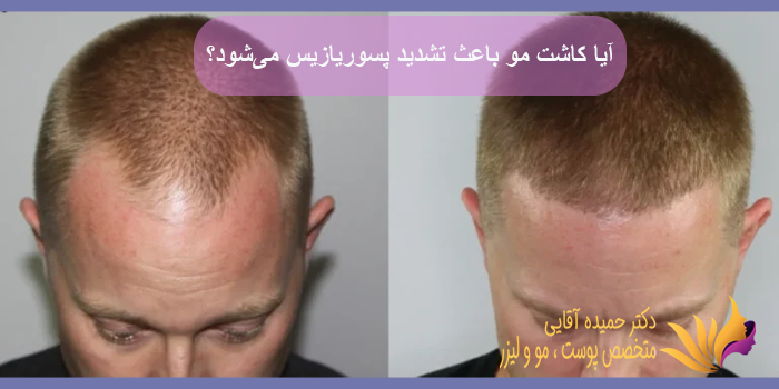 آیا کاشت مو باعث تشدید پسوریازیس میشود؟