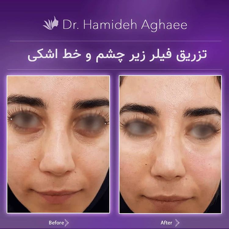 تزریق فیلر زیر جشم و خط اشکی