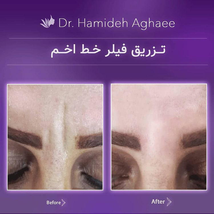 تزریق فیلر خط اخم