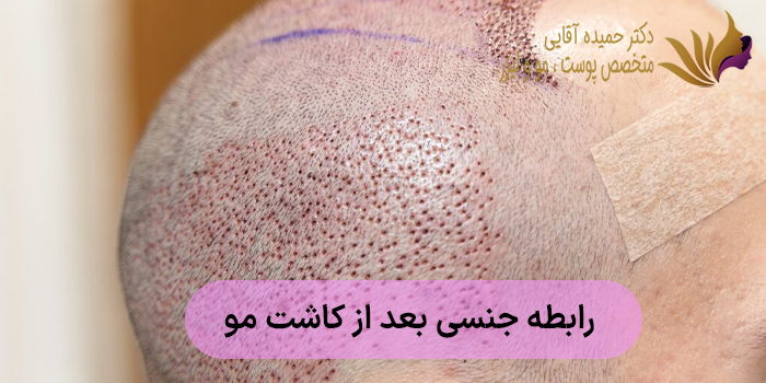 رابطه جنسی بعد از کاشت مو