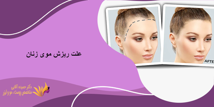 کاشت مو برای زنان