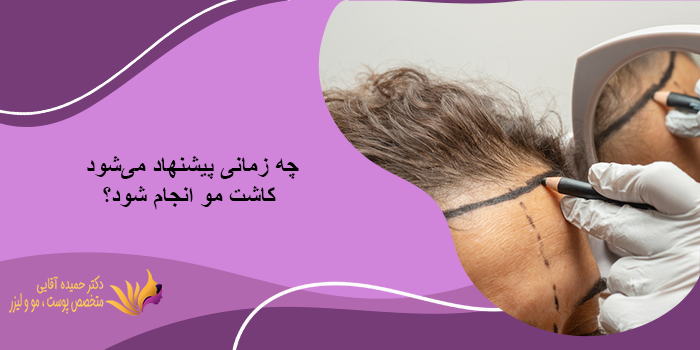 مراقبتهای بعد از کاشت مو برای زنان