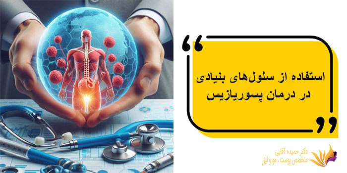 استفاده از سلولهای بنیادی در درمان پسوریازیس