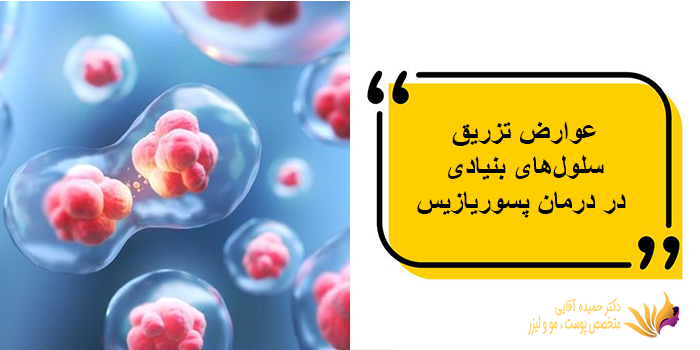 عوارض تزریق سلولهای بنیادی در درمان پسوریازیس