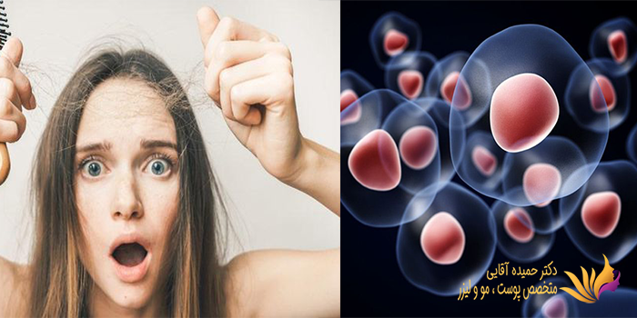 مزایای درمان ریزش مو با سلول های بنیادی