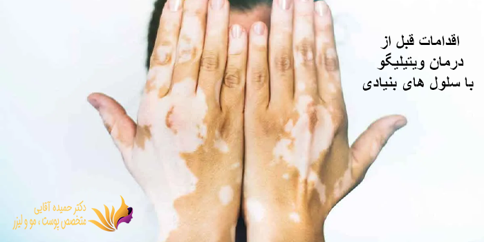 اقدامات قبل از درمان ویتیلیگو با سلول های بنیادی