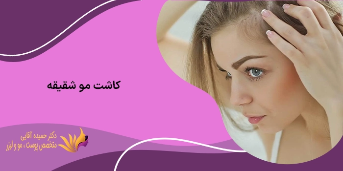 کاشت مو شقیقه