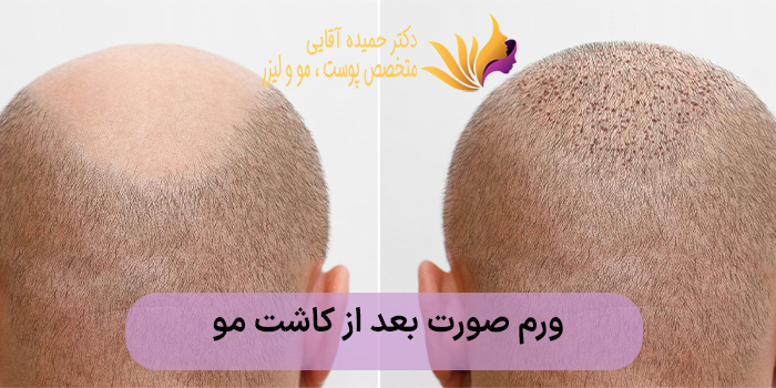 ورم صورت بعد از کاشت مو