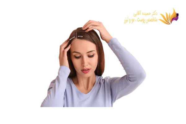 عوامل موثر بر ماندگاری کاشت مو