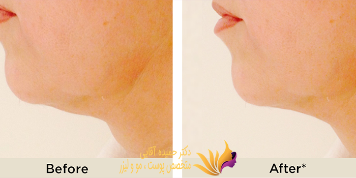 اندولیفت غبغب