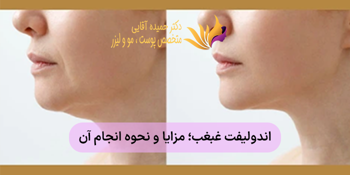 اندولیفت غبغب؛ مزایا و نحوه انجام آن