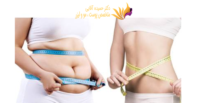 مراقبت های بعد از اندولیفت لاغری