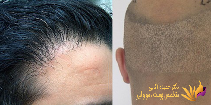 عوارض کاشت مو