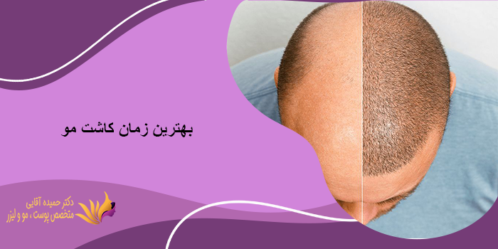 بهترین زمان کاشت مو چه زمانی است؟