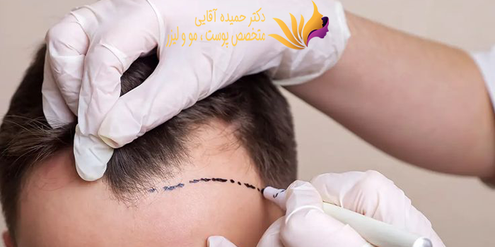 عوارض کاشت مو پس از چند روز بعد از عمل ظاهر میشود؟