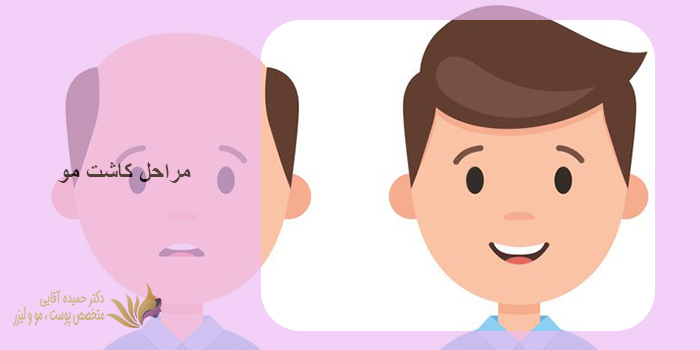 مراحل کاشت مو