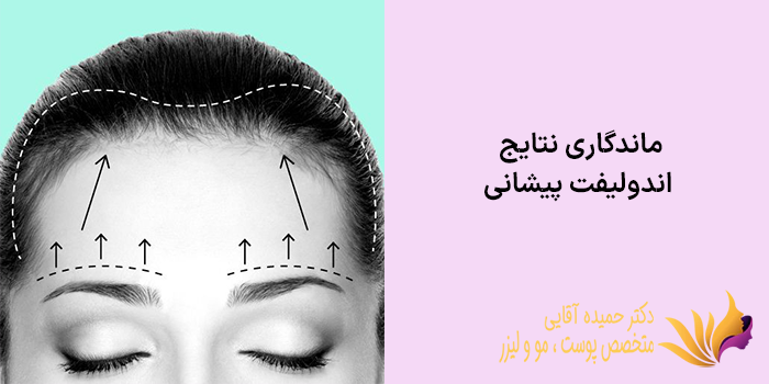 ماندگاری نتایج اندولیفت پیشانی