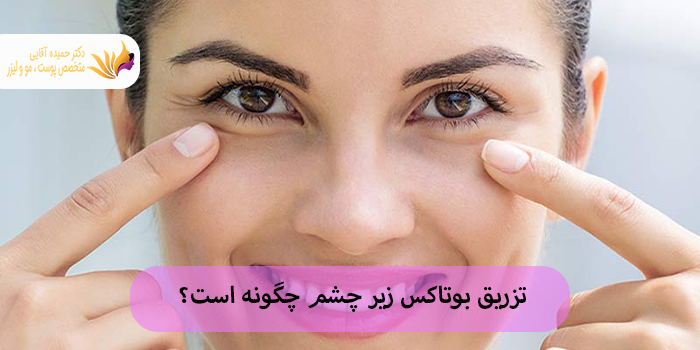 تزریق بوتاکس زیر چشم