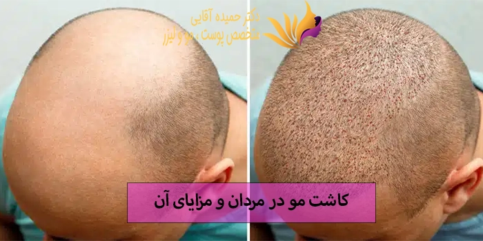 کاشت مو در مردان