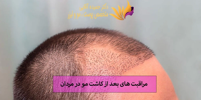 مراقبت های بعد از کاشت مو در مردان