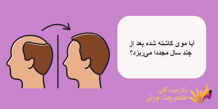 آیا موی کاشته شده بعد از چند سال مجددا میریزد؟