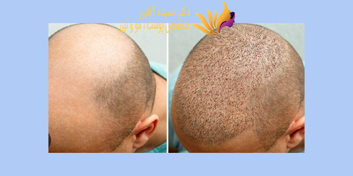 ورم، خارش و درد بعد از کاشت مو؛ طبیعی یا نگران کننده است؟