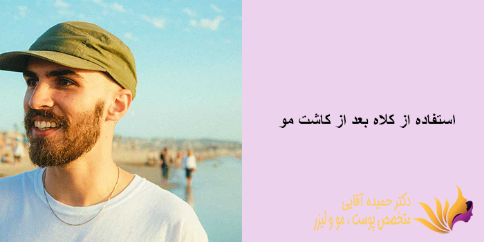 استفاده از کلاه بعد از کاشت مو