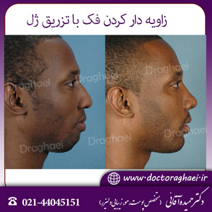 زاویه دار کردن فک با تزریق ژل