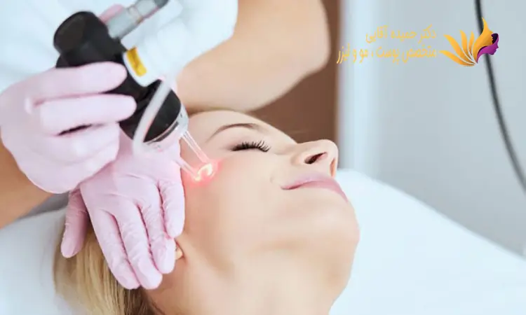 لیزر موهای زائد صورت چیست؟