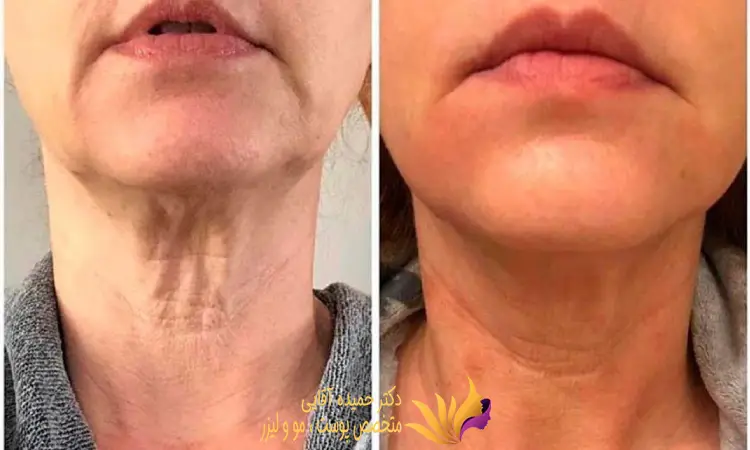 نتایج استفاده از لیزر اندولیفت