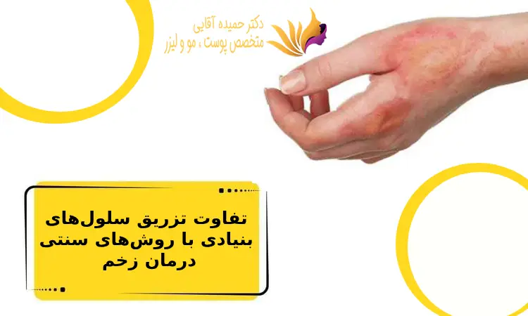 تفاوت تزریق سلولهای بنیادی با روشهای سنتی درمان زخم