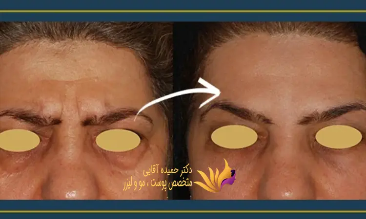 اندولیفت پیشانی چگونه انجام می شود؟