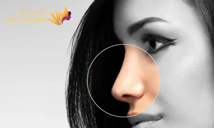 لیزر اندولیفت بینی چیست؟