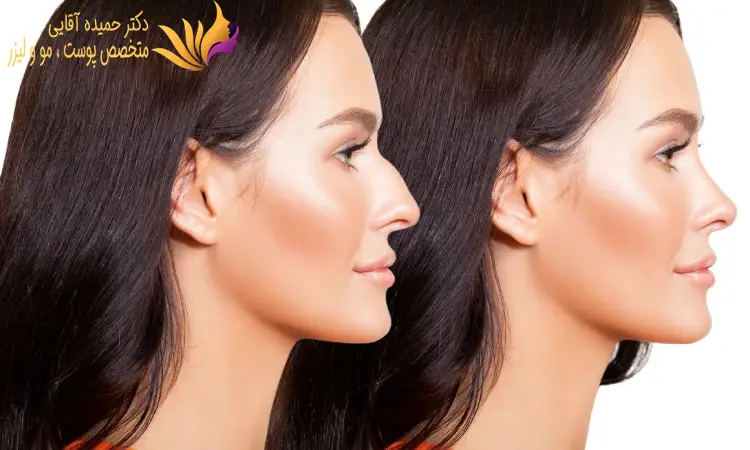 ماندگاری نتایج لیزر اندولیفت بینی