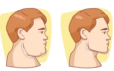 لیزر اندولیفت چانه و مزایای آن