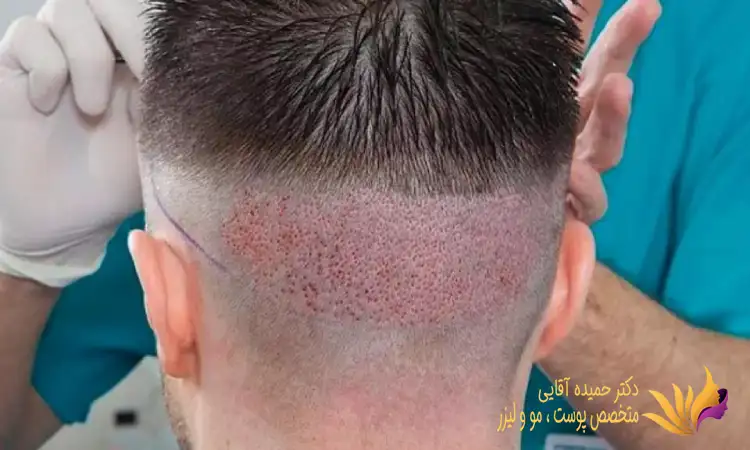 انواع روش های کاشت مو کداماند؟