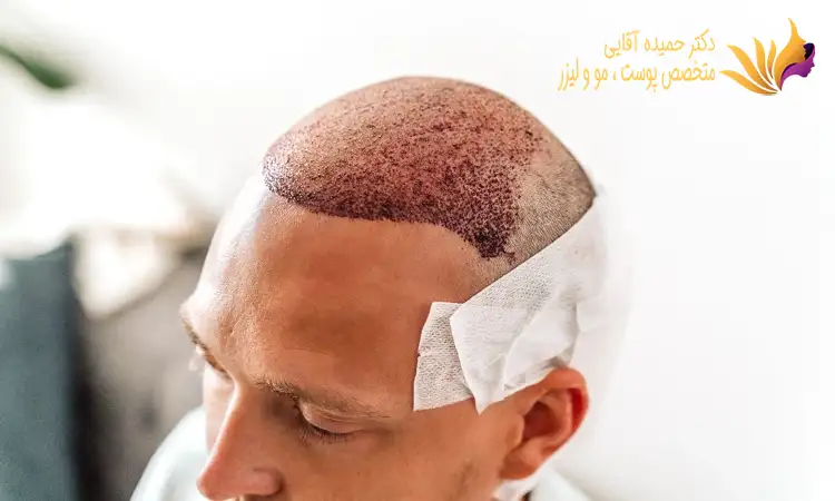 عوامل تاثیر گذار بر روش های کاشت مو