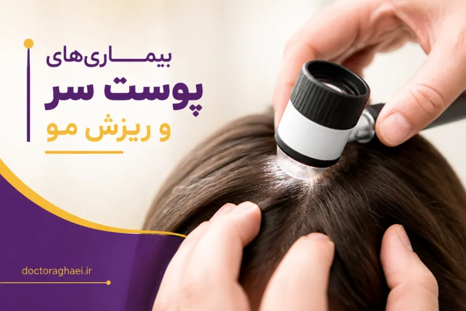 بیماریهای پوست سر و ریزش مو — معاینه پوست سر و بررسی علت ریزش مو با درموسکوپ