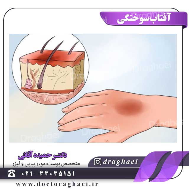 آفتاب سوختگی