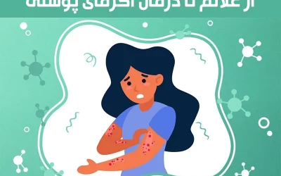 درمان اگزمای پوستی