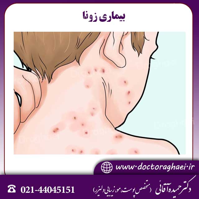 بیماری زونا