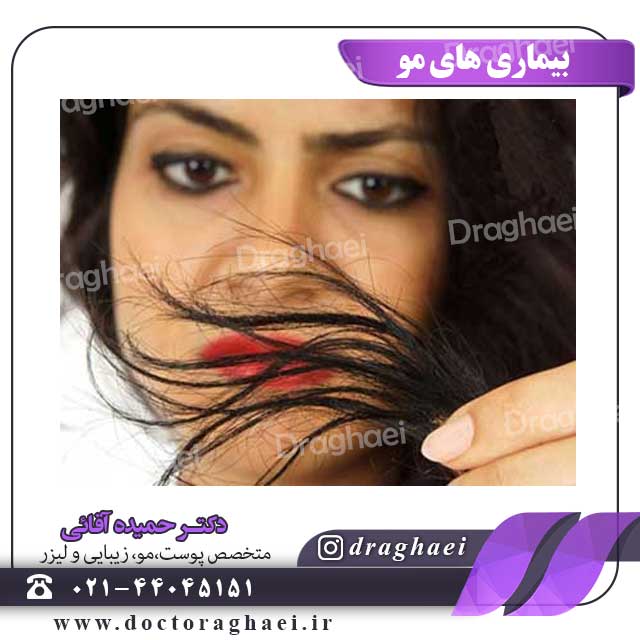 بیماری های مو