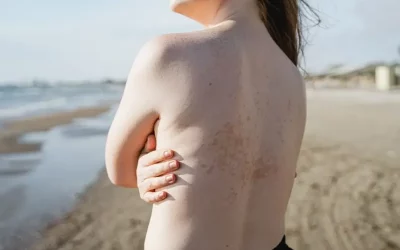 تغییرات آب و هوایی چگونه بر بیماری های پوستی تأثیر می گذارد؟