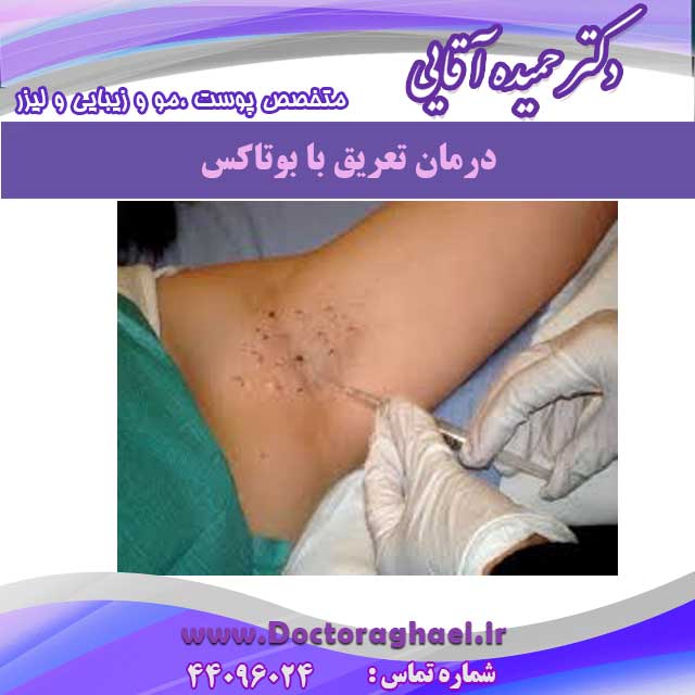 تزریق بوتاکس زیر بغل برای کاهش تعریق زیاد